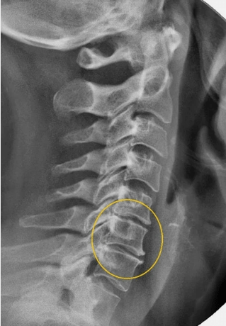 Ostéochondrose de la colonne cervicale sur une rayon x