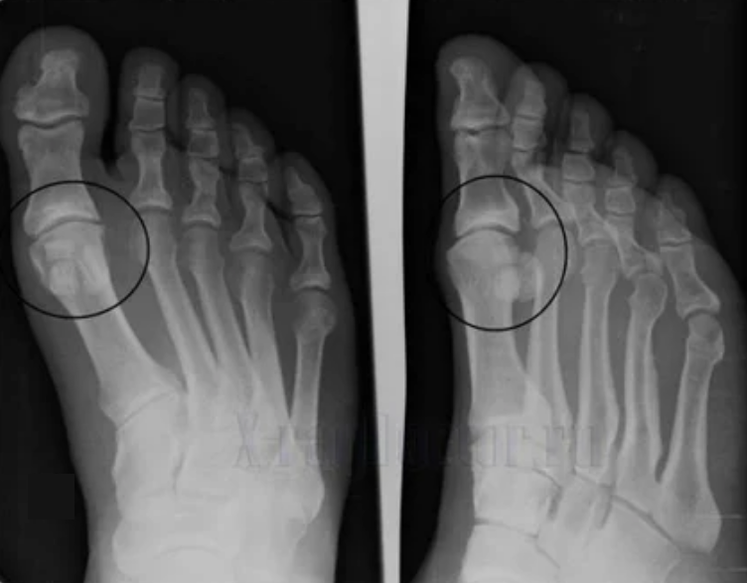 Diagnostic d'arthrose