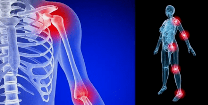 déformation des membres pour l'arthrose