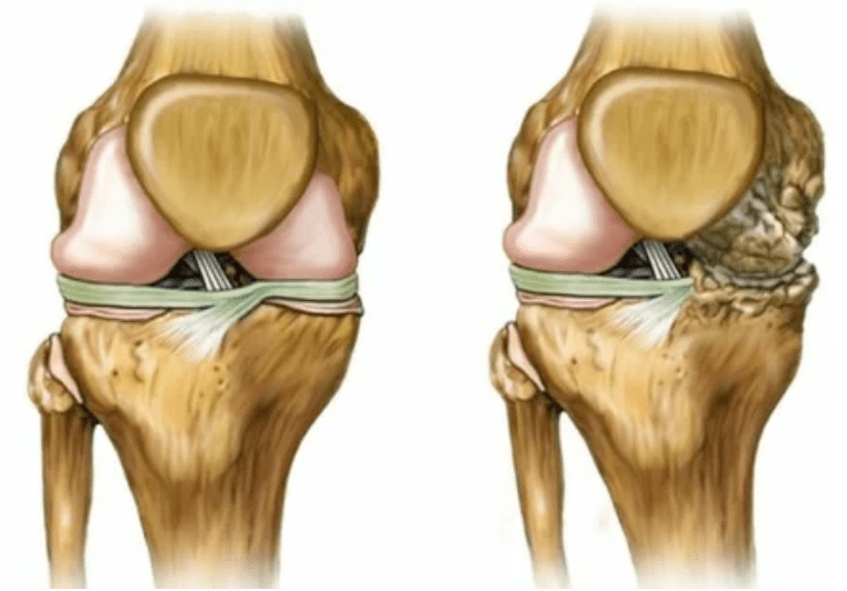 Étapes de l'arthrose