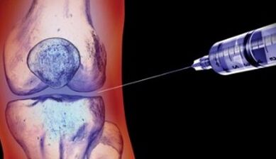 méthodes de traitement de l'arthrose articulaire