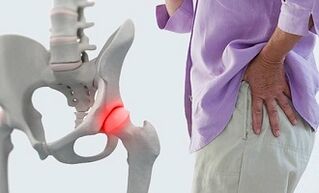 causes de l'arthrose de l'articulation de la hanche
