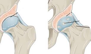 stades de développement de l'arthrose de la hanche