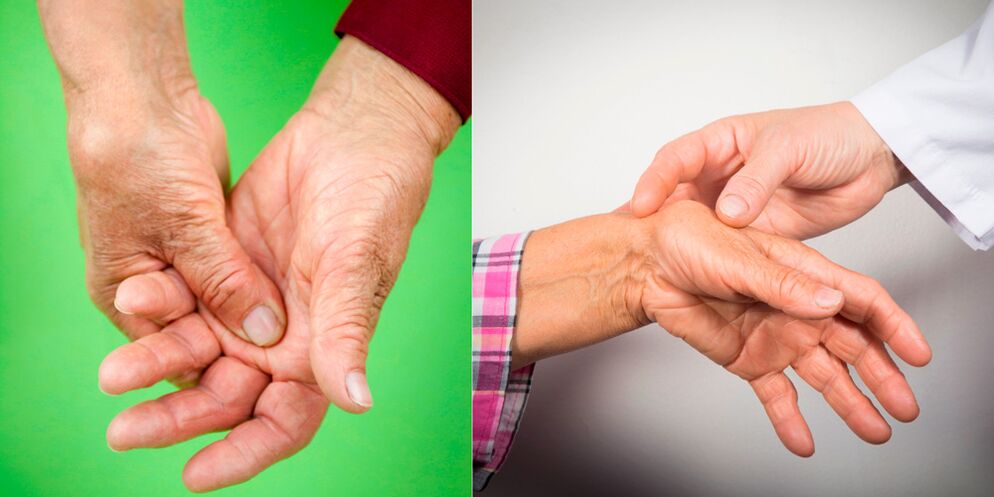 l'enflure et les douleurs douloureuses sont les premiers signes de l'arthrite de la main