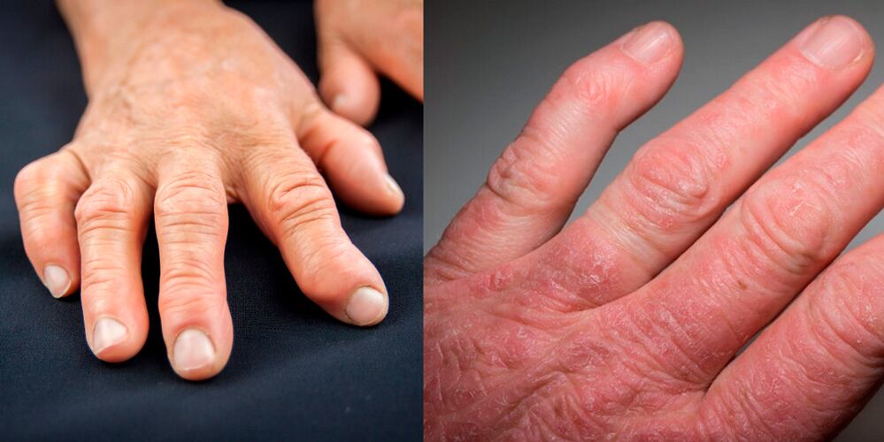 polyarthrite rhumatoïde et psoriasique des mains