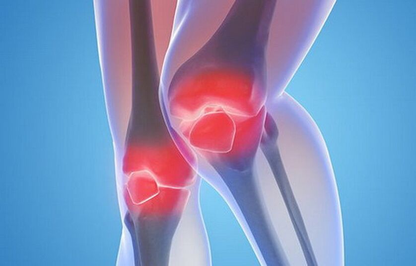 arthrose des articulations du genou