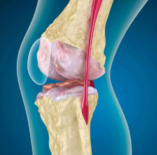 L'arthrose de l'articulation du genou
