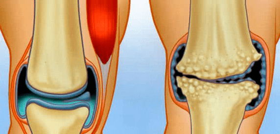 Articulation et arthrose normales
