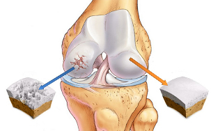 l'arthrose de l'articulation du genou